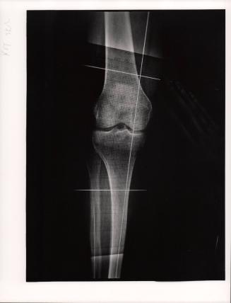 Hospital for Special Surgery (Knee X-Ray)